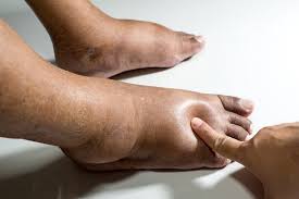 Foot swelling